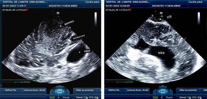 左圖顯示術(shù)中超聲見(jiàn)囊實(shí)性病變，大小約為4x4x3cm，病灶周圍腦組織水腫明顯；右圖為病灶切除后，術(shù)中超聲示術(shù)腔無(wú)病變殘留