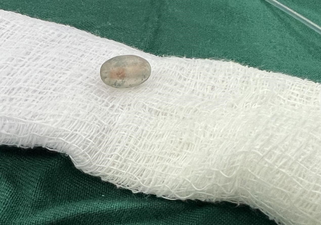 被取出的異物。中國(guó)援桑醫(yī)療隊(duì)供圖