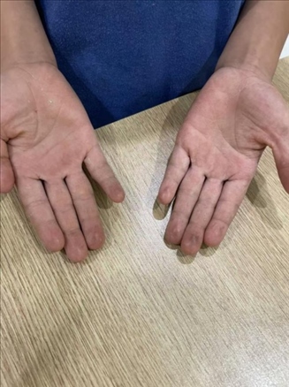 9歲小學(xué)生長(zhǎng)期拍煙卡，手部粗糙長(zhǎng)繭。受訪者供圖