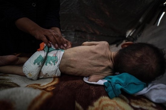 這是5月28日在加沙城西部一處臨時安置點拍攝的一名營養(yǎng)不良的嬰兒。新華社發(fā)（馬哈茂德·扎基攝）